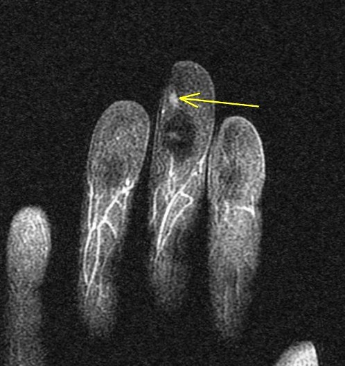 Figure 5 for case glomus tumor ( RID4513 )